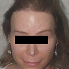 Compare Before & After Photos of _procedure_photos.phpSex Reassignment Surgery (Male to Female)