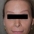 Compare Before & After Photos of _procedure_photos.phpSex Reassignment Surgery (Male to Female)