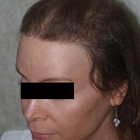 Compare Before & After Photos of _procedure_photos.phpSex Reassignment Surgery (Male to Female)