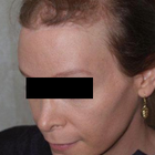 Compare Before & After Photos of _procedure_photos.phpSex Reassignment Surgery (Male to Female)