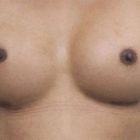 Compare Before & After Photos of _procedure_photos.phpSex Reassignment Surgery (Male to Female)