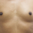 Compare Before & After Photos of _procedure_photos.phpSex Reassignment Surgery (Male to Female)