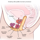 Compare Before & After Photos of _procedure_photos.phpSex Reassignment Surgery (Male to Female)