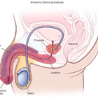 Compare Before & After Photos of _procedure_photos.phpSex Reassignment Surgery (Male to Female)