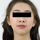 Compare Before & After Photos of _procedure_photos.phpSex Reassignment Surgery (Male to Female)