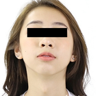 Compare Before & After Photos of _procedure_photos.phpSex Reassignment Surgery (Male to Female)