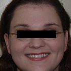 Compare Before & After Photos of _procedure_photos.phpSex Reassignment Surgery (Male to Female)
