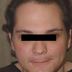 Compare Before & After Photos of _procedure_photos.phpSex Reassignment Surgery (Male to Female)