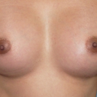 Compare Before & After Photos of _procedure_photos.phpSex Reassignment Surgery (Male to Female)