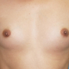 Compare Before & After Photos of _procedure_photos.phpSex Reassignment Surgery (Male to Female)