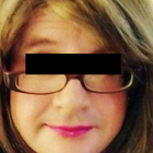 Compare Before & After Photos of _procedure_photos.phpSex Reassignment Surgery (Male to Female)