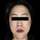 Compare Before & After Photos of _procedure_photos.phpSex Reassignment Surgery (Male to Female)