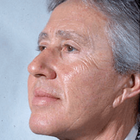 Compare Before & After Photos of _procedure_photos.phpFacelift