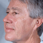 Compare Before & After Photos of _procedure_photos.phpFacelift