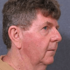 Compare Before & After Photos of _procedure_photos.phpFacelift