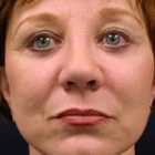 Compare Before & After Photos of _procedure_photos.phpFacelift