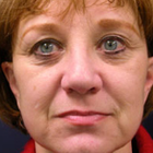 Compare Before & After Photos of _procedure_photos.phpFacelift