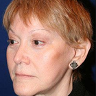 Compare Before & After Photos of _procedure_photos.phpFacelift