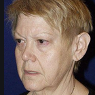 Compare Before & After Photos of _procedure_photos.phpFacelift