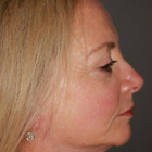 Compare Before & After Photos of _procedure_photos.phpFacelift