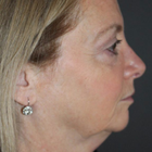 Compare Before & After Photos of _procedure_photos.phpFacelift