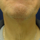Compare Before & After Photos of _procedure_photos.phpFacelift