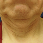 Compare Before & After Photos of _procedure_photos.phpFacelift