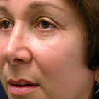 Compare Before & After Photos of _procedure_photos.phpFacelift