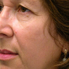 Compare Before & After Photos of _procedure_photos.phpFacelift