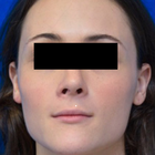 Compare Before & After Photos of _procedure_photos.phpFacial Feminization Surgery (FFS)