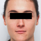 Compare Before & After Photos of _procedure_photos.phpFacial Feminization Surgery (FFS)