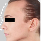 Compare Before & After Photos of _procedure_photos.phpFacial Feminization Surgery (FFS)