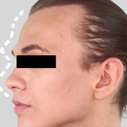 Compare Before & After Photos of _procedure_photos.phpFacial Feminization Surgery (FFS)