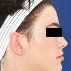 Compare Before & After Photos of _procedure_photos.phpFacial Feminization Surgery (FFS)