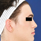 Compare Before & After Photos of _procedure_photos.phpFacial Feminization Surgery (FFS)