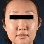 Compare Before & After Photos of _procedure_photos.phpFacial Feminization Surgery (FFS)