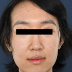 Compare Before & After Photos of _procedure_photos.phpFacial Feminization Surgery (FFS)