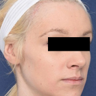 Compare Before & After Photos of _procedure_photos.phpFacial Feminization Surgery (FFS)