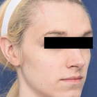 Compare Before & After Photos of _procedure_photos.phpFacial Feminization Surgery (FFS)