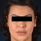 Compare Before & After Photos of _procedure_photos.phpFacial Feminization Surgery (FFS)