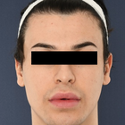 Compare Before & After Photos of _procedure_photos.phpFacial Feminization Surgery (FFS)