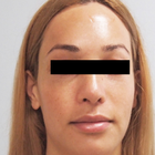 Compare Before & After Photos of _procedure_photos.phpFacial Feminization Surgery (FFS)
