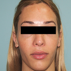 Compare Before & After Photos of _procedure_photos.phpFacial Feminization Surgery (FFS)