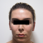 Compare Before & After Photos of _procedure_photos.phpFacial Feminization Surgery (FFS)