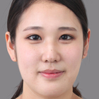 Compare Before & After Photos of _procedure_photos.phpDouble Eyelid Creation