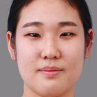 Compare Before & After Photos of _procedure_photos.phpDouble Eyelid Creation