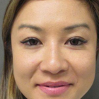 Compare Before & After Photos of _procedure_photos.phpDouble Eyelid Creation