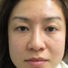 Compare Before & After Photos of _procedure_photos.phpDouble Eyelid Creation