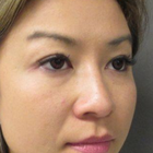 Compare Before & After Photos of _procedure_photos.phpDouble Eyelid Creation