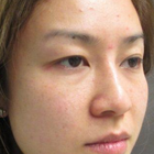 Compare Before & After Photos of _procedure_photos.phpDouble Eyelid Creation